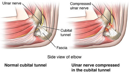 Cubital Tunnel Syndrome Salem, OR  Medial Epicondylectomy Corvallis, OR