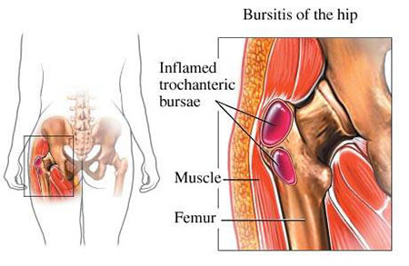 Hip Bursitis Treatment - Denver Hip Care