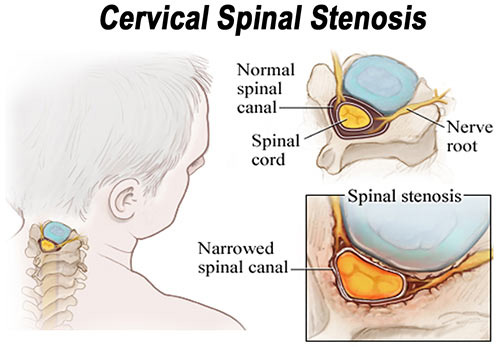 Spinal Stenosis Surgery & Treatments