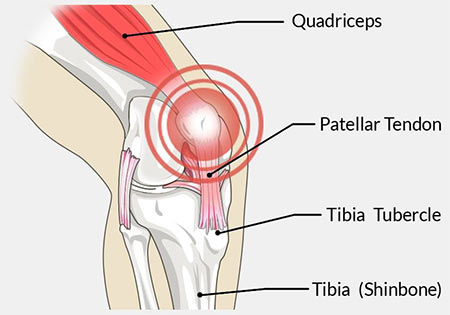 https://www.sportspainmanagementnyc.com/wp-content/uploads/2018/03/Patellar-Tendonitis-Treatment-Doctor-Knee-Specialist-NYC.jpg