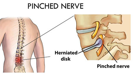 Pinched Nerve in Lower Back: Causes, Symptoms, and Treatments