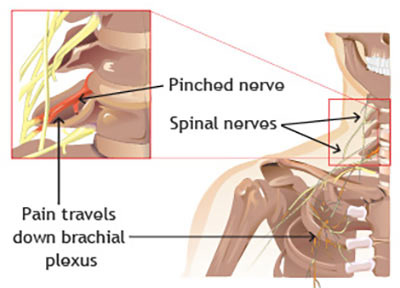 compressed nerve in neck