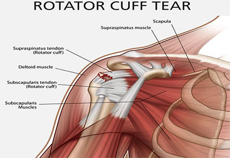 Rotator Cuff Tears, Injuries and Treatments