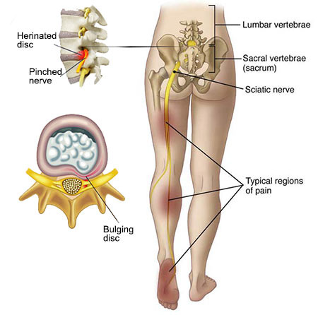 Treatment For Severe Sciatica When Medication And Physical Therapy Don't Work