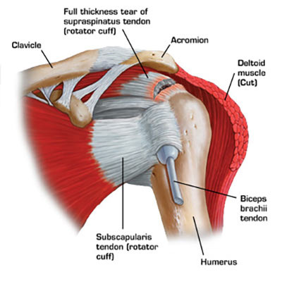Everything You Need to Know about Rotator Cuff Tear Treatment in NYC