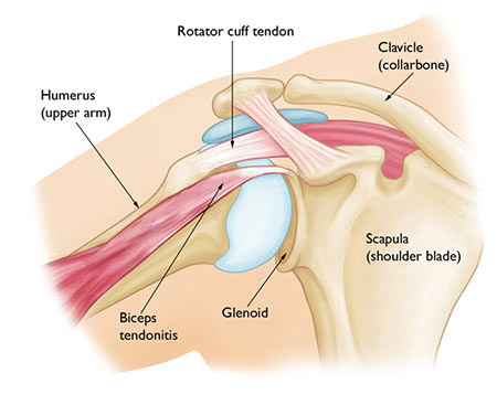 shoulder muscle strain