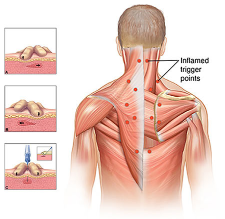 Trigger Point Injections NYC  Manhattan Myofascial Pain Relief