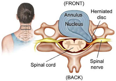 Spinal Cord Stimulation in NYC  Sports Injury & Pain Management Clinic