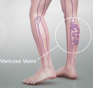 How to Treat Varicose Veins — Dermatologist Advice and Recommendations